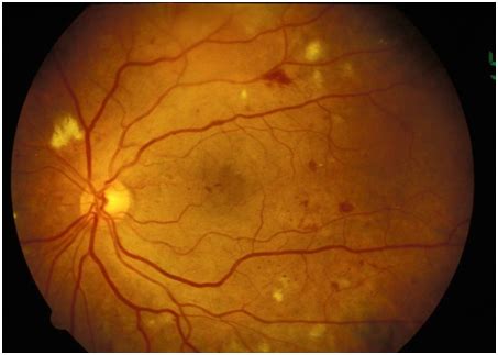 Patients With Severe Nonproliferative Diabetic Retinopathy Should Avoid - DiabetesWalls