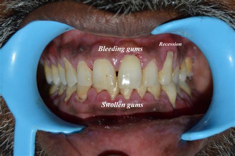 Early Signs of Gum Disease – DT Smile Care