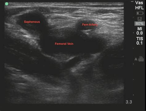 A Swollen Leg (2013) | Emory School of Medicine