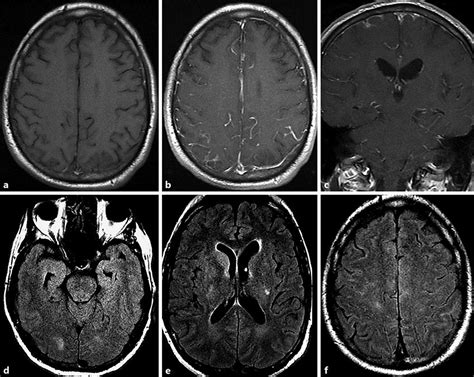 Abnormal Brain Mri Results