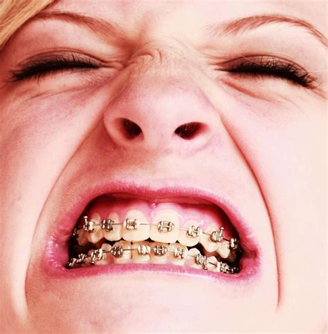 File:Free Awesome Girl With Braces Close Up.jpg - Wikimedia Commons