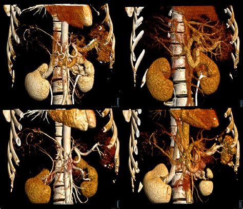 Figure 2 from The image quality of CT angiography images calculated from 70kVp liver perfusion ...