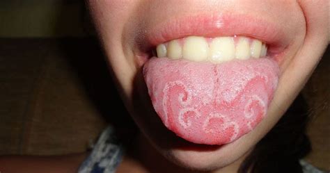 9 Things Your Tongue Is Trying To Tell You About Your Health