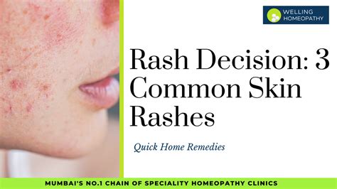 Rash Decision: 3 Common Skin Rashes And Quick Home Remedies