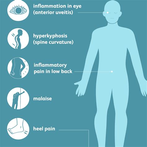 Ankylosing spondylitis - Symptoms, Causes &Treatment - Santripty