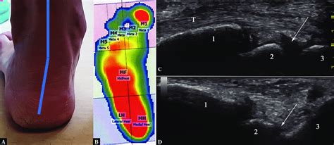 Example of RA patients with hindfoot valgus. A. Clinical aspect of the ...