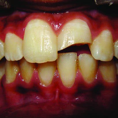 Ellis class III fracture of the maxillary left central incisor | Download Scientific Diagram