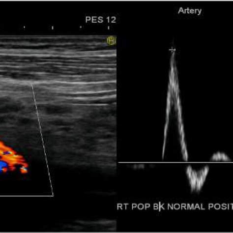 Duplex ultrasound image of the popliteal artery below the knee Doppler... | Download Scientific ...