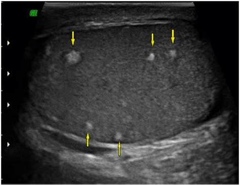 Ultrasound sagittal view demonstrate multiple ill-defined hyperechoic... | Download Scientific ...