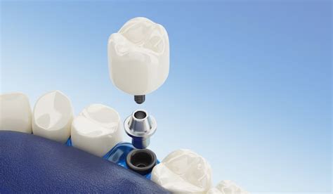 Ceramic Dental Implants - Vancouver Dental Implant