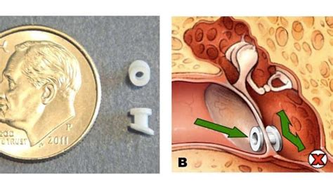 Fluid In Ear Draining