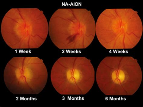 정상안압녹내장, NTG, Normal tension glaucoma에서의 감별진단, 진단 특징