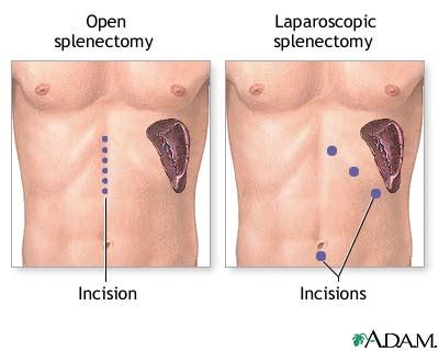 Traumatisme splina - simptome, tratament - DrBendo.ro