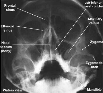 X-ray of the Skull Bones