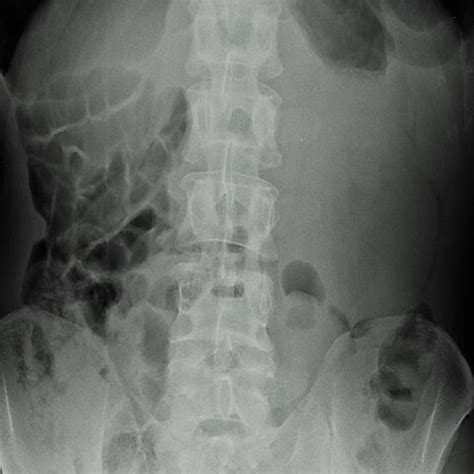 (PDF) Intussuscepted caecal cancer in a patient with intestinal malrotation and agenesis of one ...