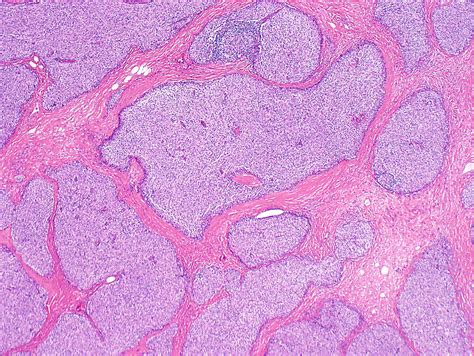 Pathology Outlines - Thymoma