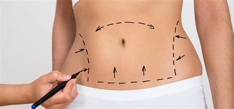 Tummy Tuck Belly Button Revision - Cosmetic Surgery Tips