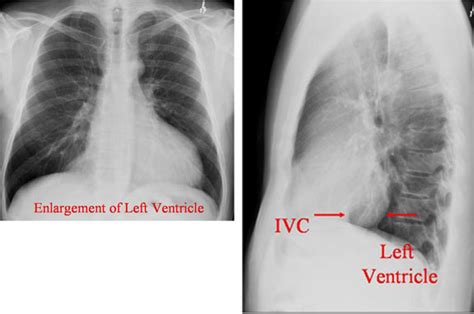 Left Ventricle Enlargement – Toronto Notes