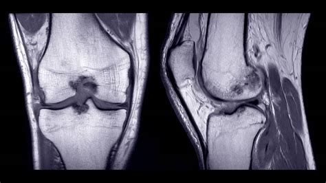 How do I manage an ACL tear in a young athlete?