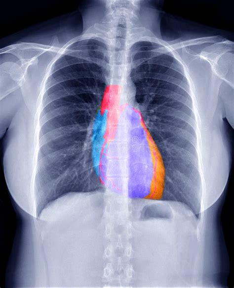 Fusion Image of Chest X-ray Image and 3D CTA Coronary Artery Image. Stock Photo - Image of ...