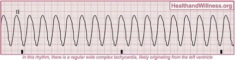 How to Read an EKG Rhythm Strip | Health And Willness (2022)