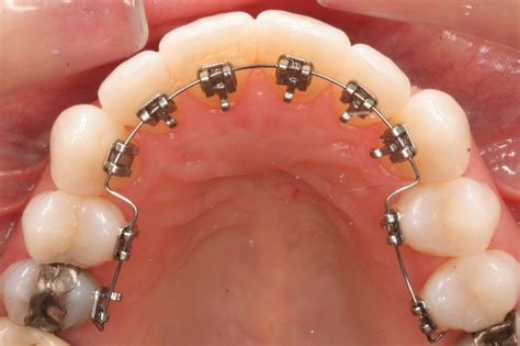 How Much Do Braces Cost in the UK? - The Dental Guide