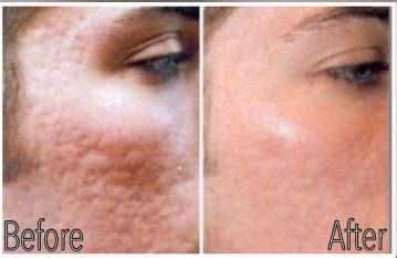 micro needling for acne scars - pictures, photos