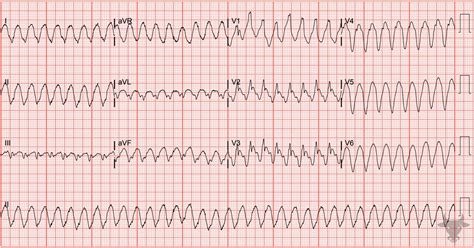 Ventricular Tachycardia | ECG Stampede