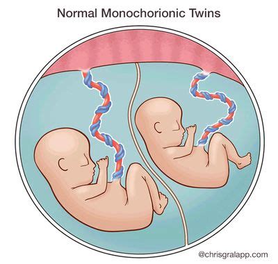 Monochorionic Twins