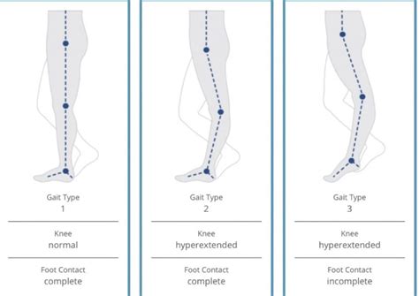 Banana Knee: Hypermobility Leading to Dysfunction and Vice Versa — BE