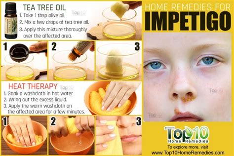 Impetigo: Home Remedies, Prevention, and When to See a Doctor | Top 10 Home Remedies