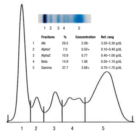 Electrophoresis Serum Protein Test Results