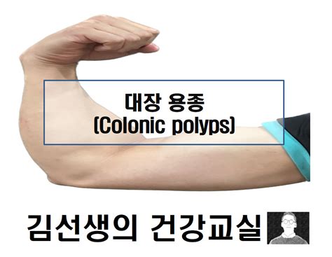 대장 용종(Colonic polyps)