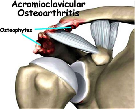 Acromioclavicular joint, acromioclavicular joint injury, separation & osteoarthritis