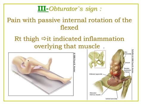 Psoas Sign And Obturator Sign