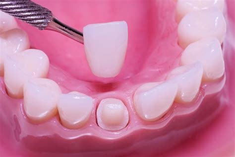 The Steps of a Dental Crown Restoration - Simply Smiles Dentistry ...