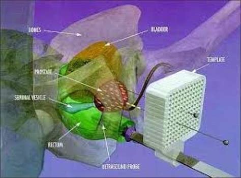 Prostate Brachytherapy - Better Healthcare Technology Foundation