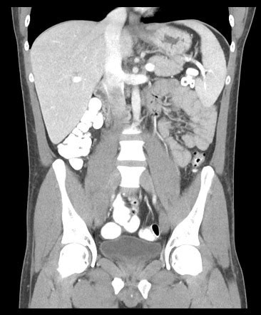 Terminal ileitis | Image | Radiopaedia.org