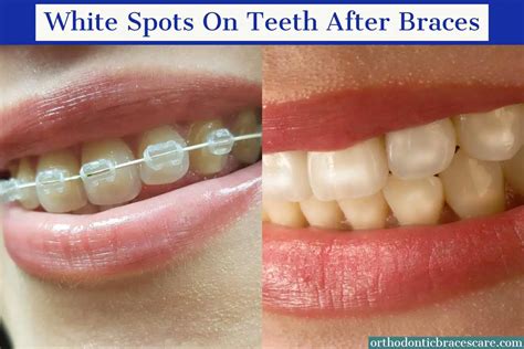 White Spots On Teeth After Braces: Causes, How to fix | Orthodontic ...