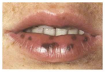 Black spots on lips-15 Causes and 10 Home remedies that work