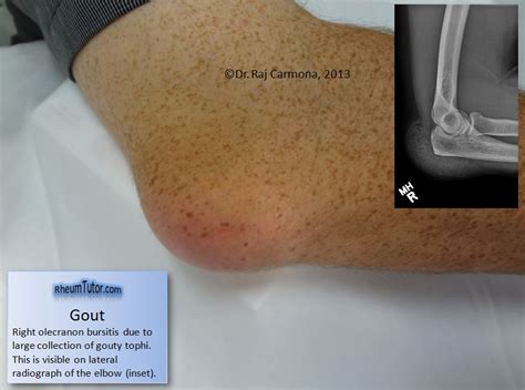 Olecranon Bursitis Gout