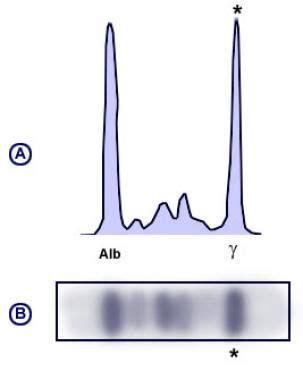 Serum Protein Electrophoresis: Reference Range, Interpretation, Collection and Panels | Serum ...