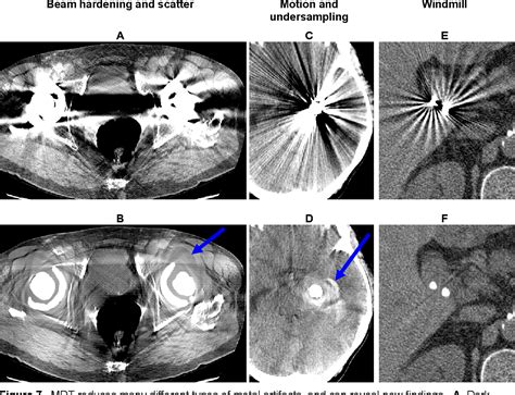 Update 117+ concentric ring artifact ct - xkldase.edu.vn