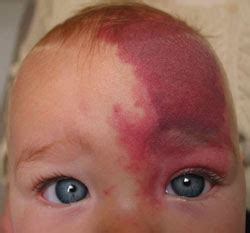 Vascular birthmarks - Toronto Dermatology Centre