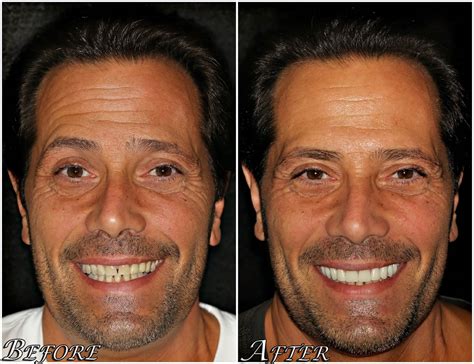 All on 4® Dental Implants Before and After Photos - Center 4 Smiles