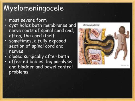 PPT - Spina Bifida PowerPoint Presentation - ID:1092120