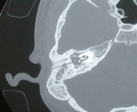 Bone Scan Fracture