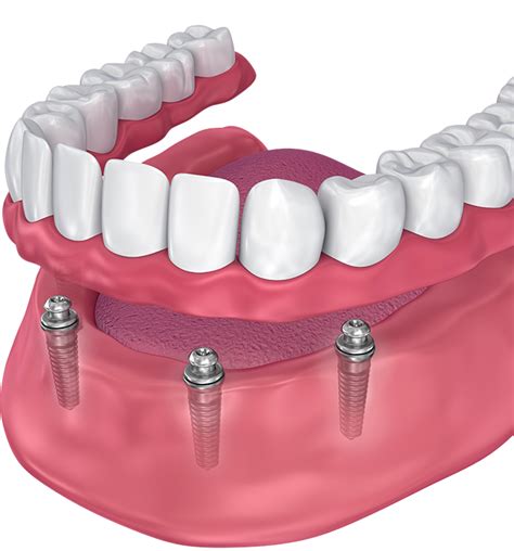 Snap-On Implant Dentures | Alta Dental | Austin, TX