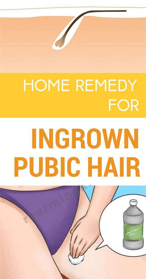 Home Remedy For Ingrown Hair | Ingrown hair remedies, Ingrown hair ...