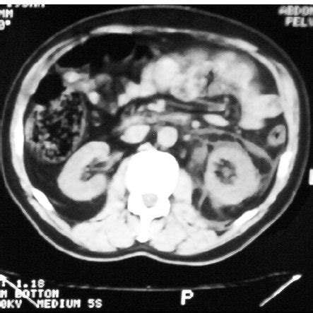 Unenhanced CT (4/17/06). Perinephric stranding, small perinephric... | Download Scientific Diagram